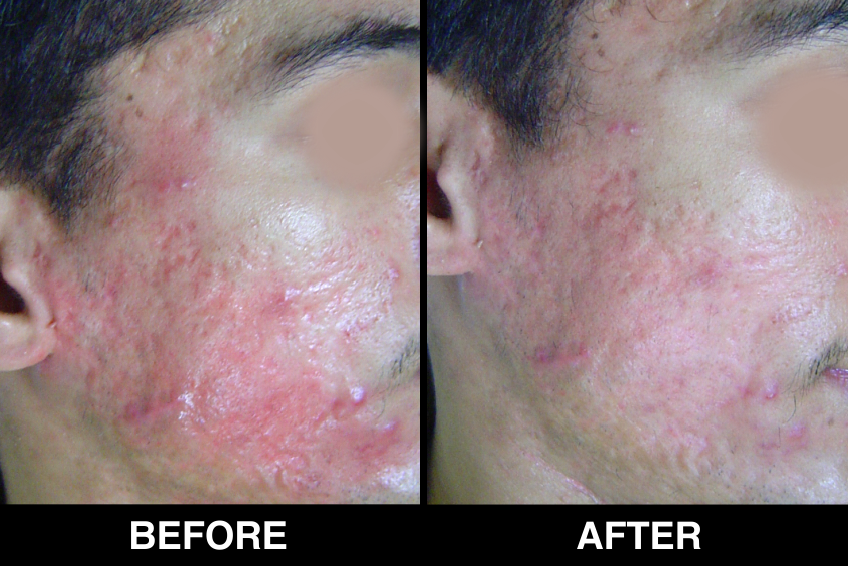 Acne-Acne-Scars1