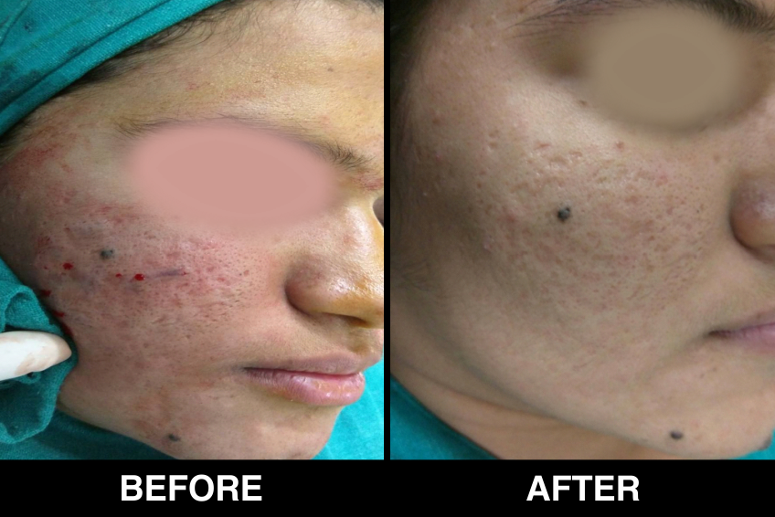 Acne-Acne-Scars2