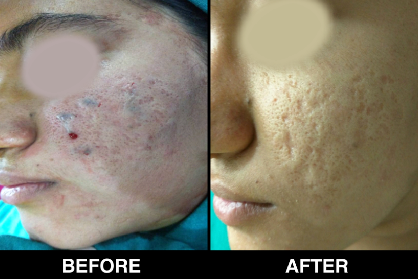 Acne-Acne-Scars29