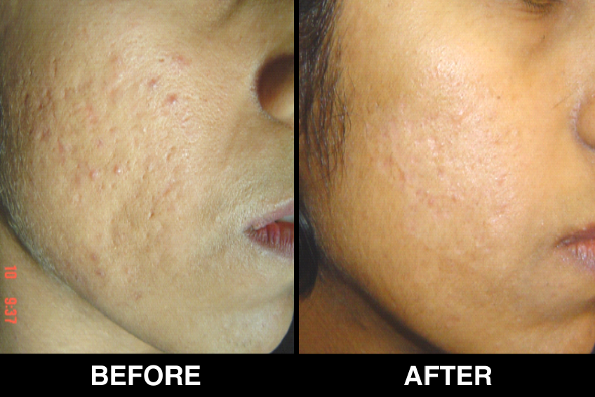 Acne-Acne-Scars30