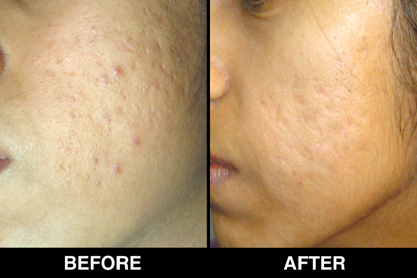 Acne-Acne-Scars31