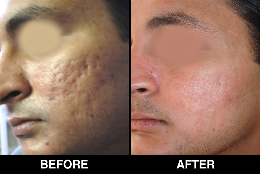 Acne-Acne-Scars4