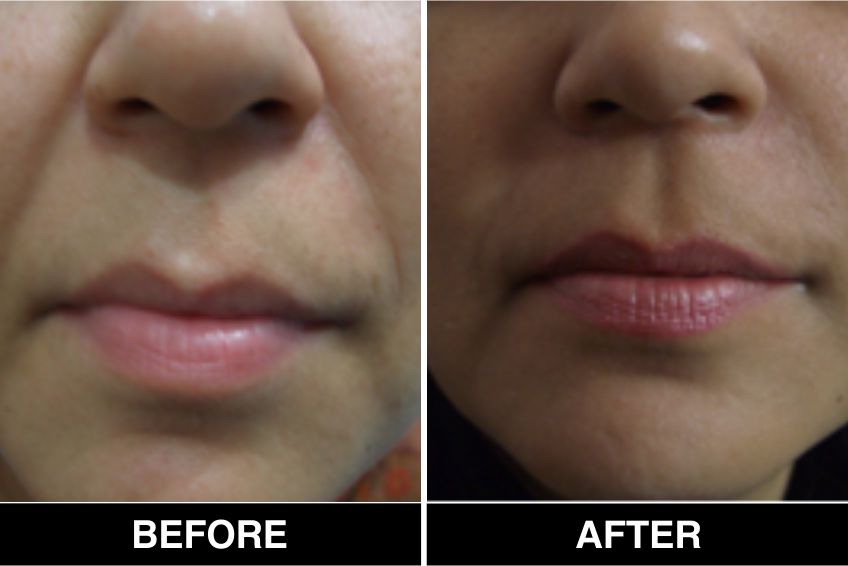 Cosmetic Fillers5