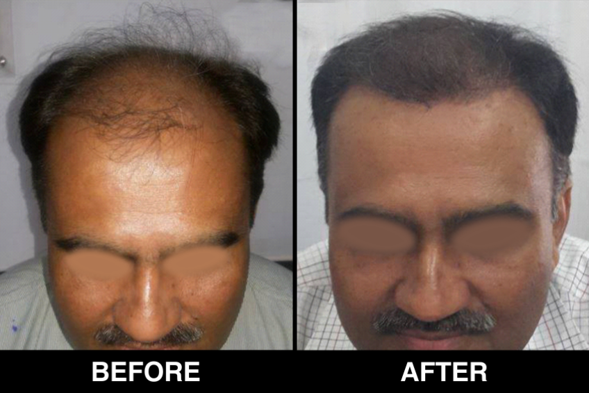 Hair-Loss-Before-After-4