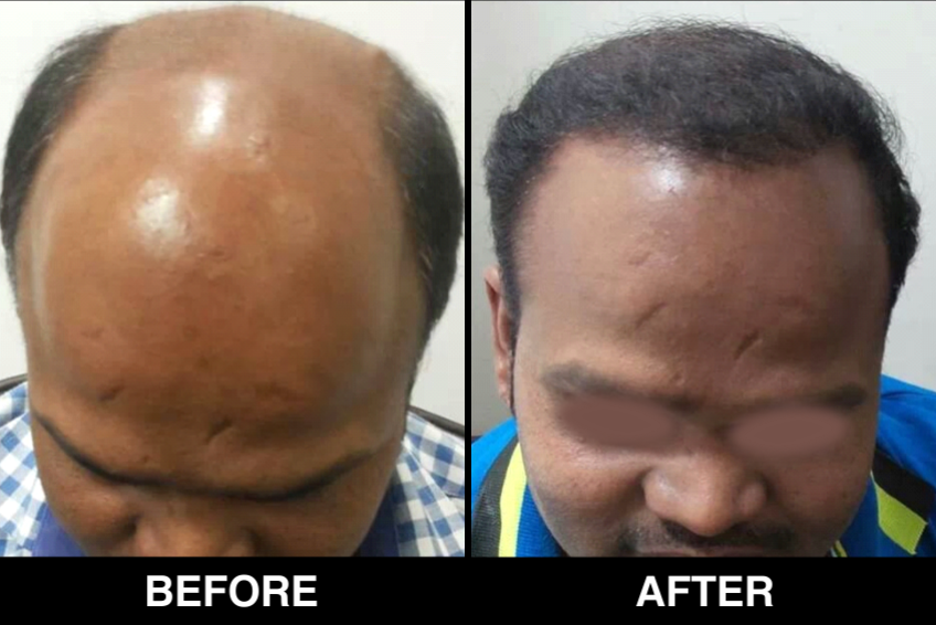 Hair-Loss-Before-After-5