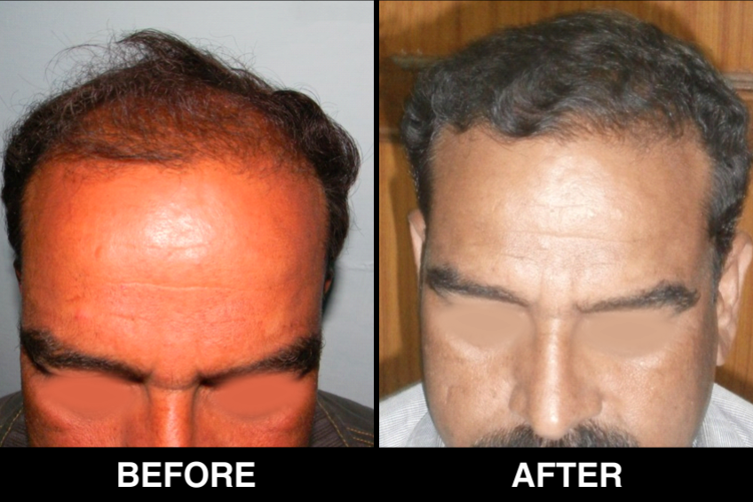 Hair-Loss-Before-After-6