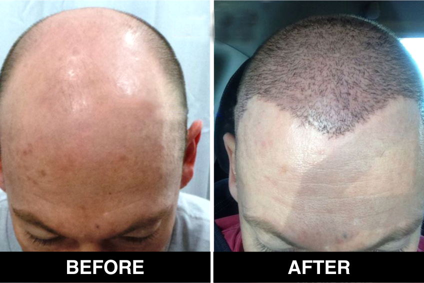 hair-transplant-6