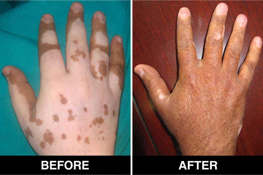 vitiligo-31