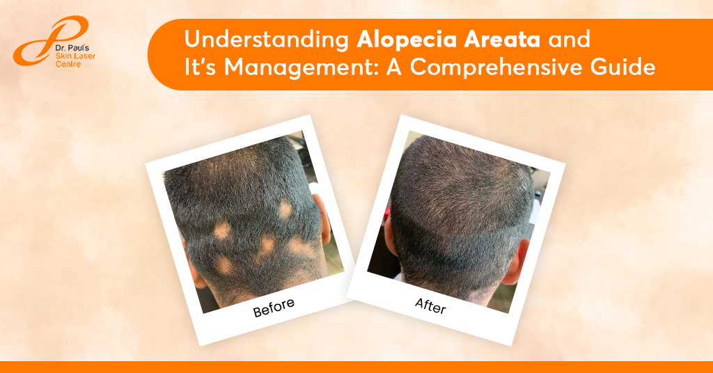 Understanding Alopecia Areata And It's Management: A Comprehensive ...