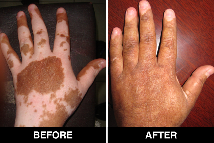 vitiligo-32